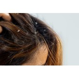 Pellicules, psoriasis, démangeaisons